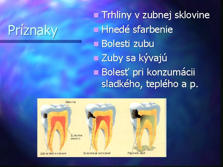 n Trhliny Príznaky v zubnej sklovine n Hnedé sfarbenie n Bolesti zubu n Zuby