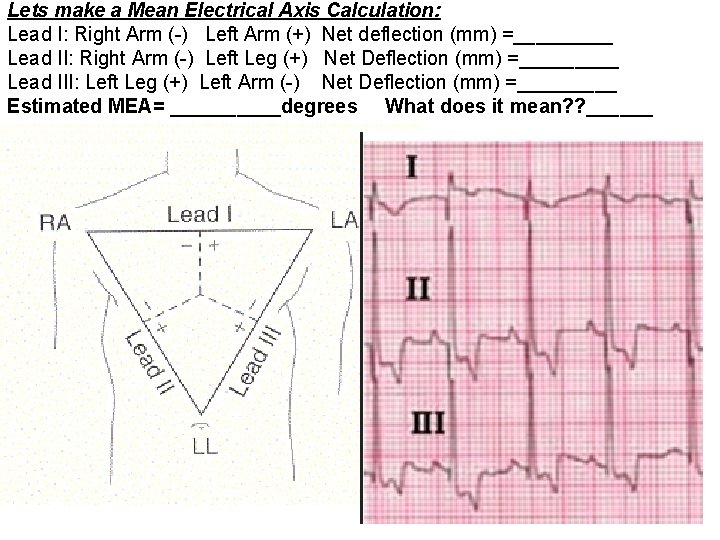 Lets make a Mean Electrical Axis Calculation: Lead I: Right Arm (-) Left Arm