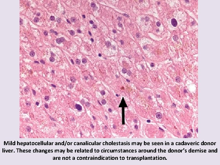 Mild hepatocellular and/or canalicular cholestasis may be seen in a cadaveric donor liver. These