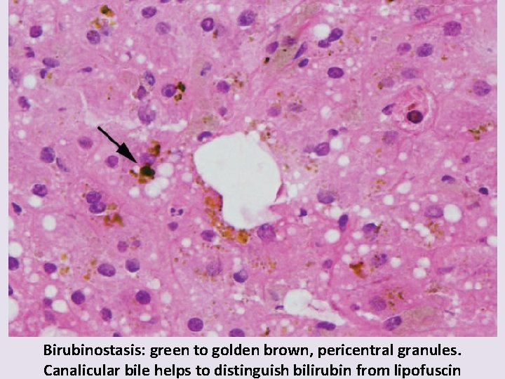 Birubinostasis: green to golden brown, pericentral granules. Canalicular bile helps to distinguish bilirubin from