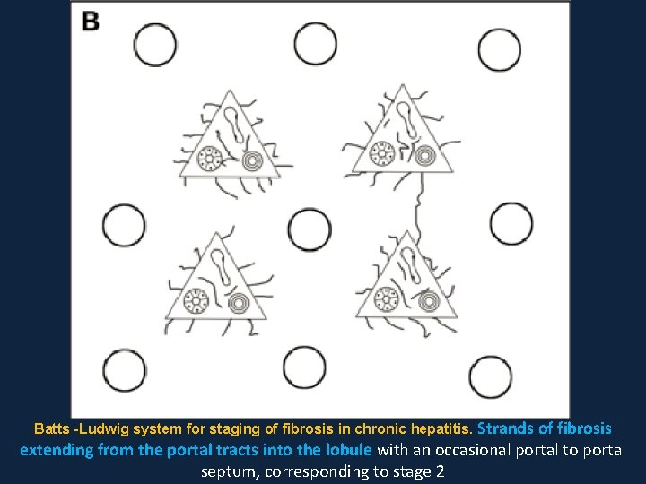 Batts -Ludwig system for staging of fibrosis in chronic hepatitis. Strands of fibrosis extending