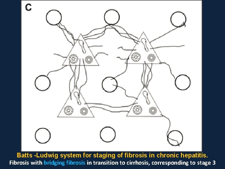 Batts -Ludwig system for staging of fibrosis in chronic hepatitis. Fibrosis with bridging fibrosis