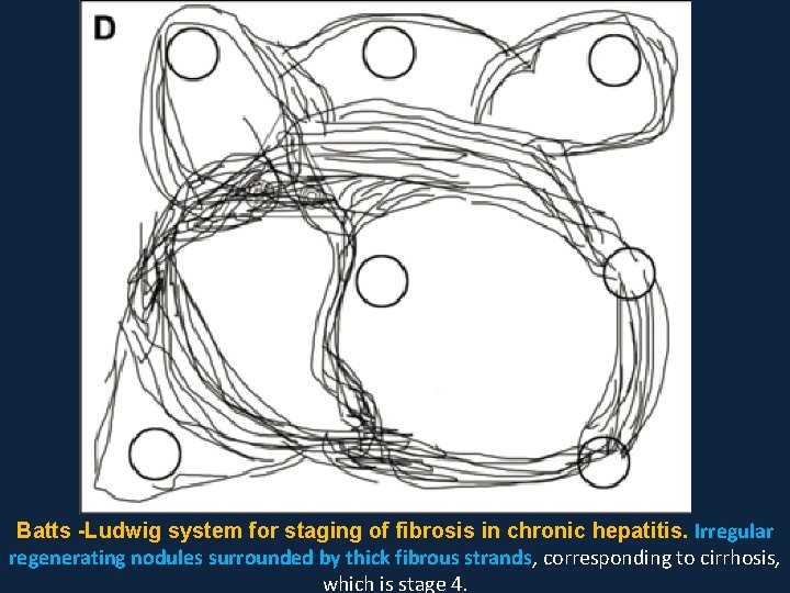 Batts -Ludwig system for staging of fibrosis in chronic hepatitis. Irregular regenerating nodules surrounded