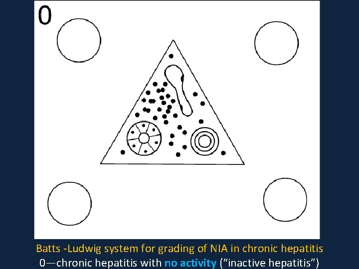 Batts -Ludwig system for grading of NIA in chronic hepatitis 0—chronic hepatitis with no