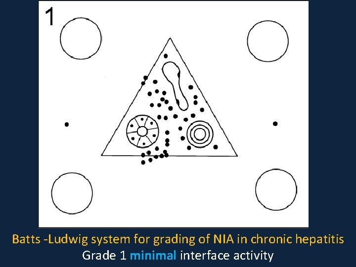 Batts -Ludwig system for grading of NIA in chronic hepatitis Grade 1 minimal interface