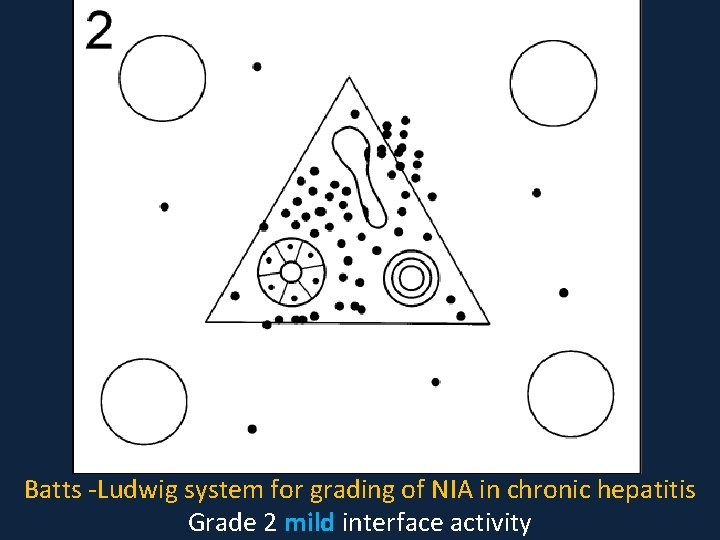 Batts -Ludwig system for grading of NIA in chronic hepatitis Grade 2 mild interface
