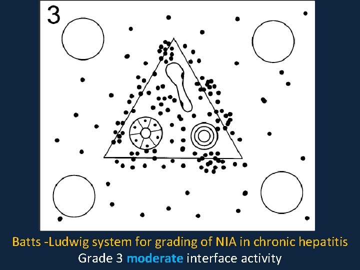 Batts -Ludwig system for grading of NIA in chronic hepatitis Grade 3 moderate interface