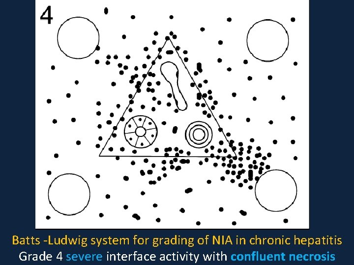 Batts -Ludwig system for grading of NIA in chronic hepatitis Grade 4 severe interface