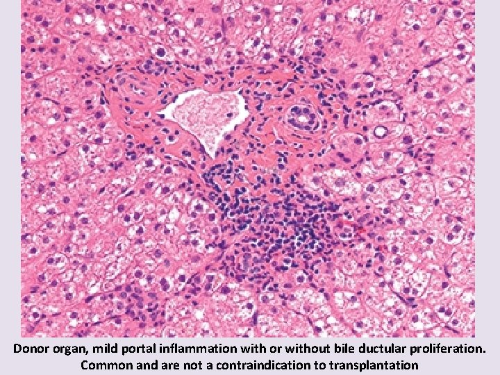 Donor organ, mild portal inflammation with or without bile ductular proliferation. Common and are