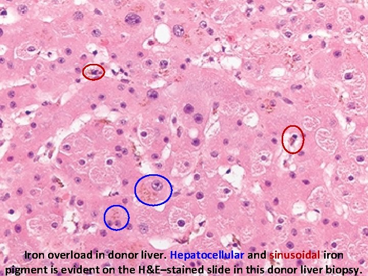 Iron overload in donor liver. Hepatocellular and sinusoidal iron pigment is evident on the