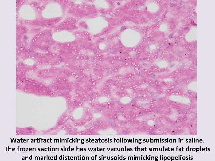 Water artifact mimicking steatosis following submission in saline. The frozen section slide has water
