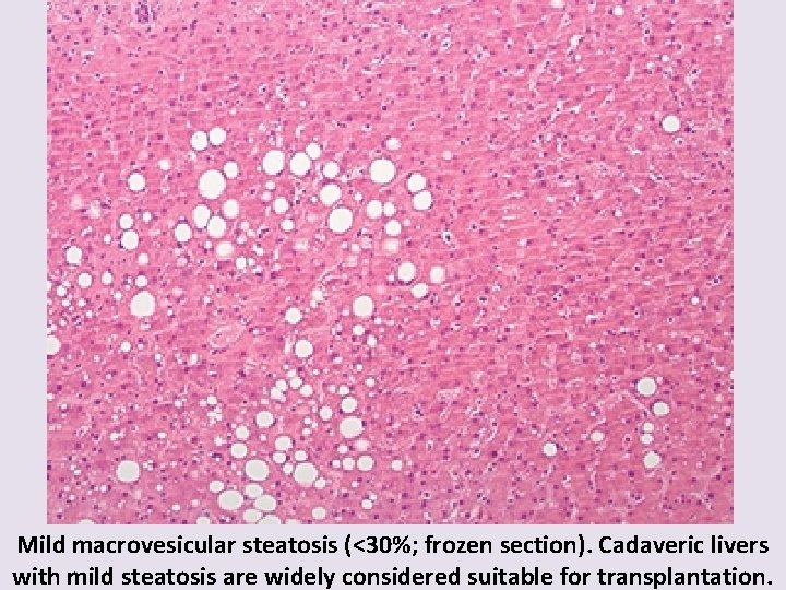 Mild macrovesicular steatosis (<30%; frozen section). Cadaveric livers with mild steatosis are widely considered