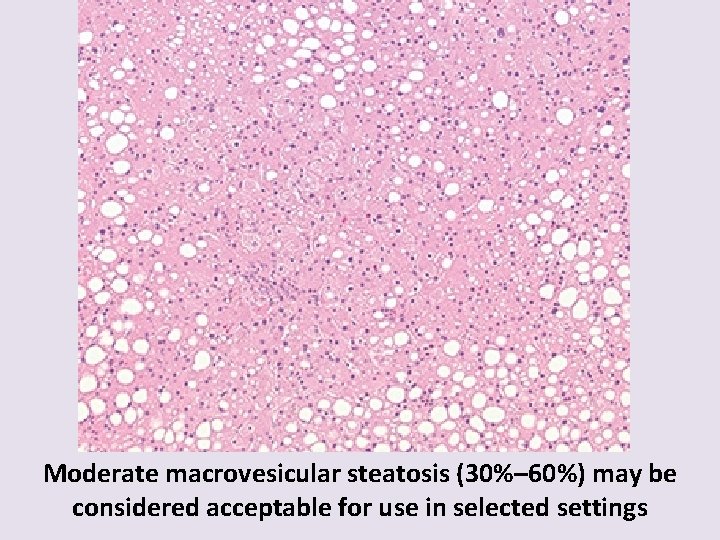 Moderate macrovesicular steatosis (30%– 60%) may be considered acceptable for use in selected settings