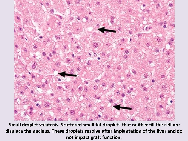 Small droplet steatosis. Scattered small fat droplets that neither fill the cell nor displace