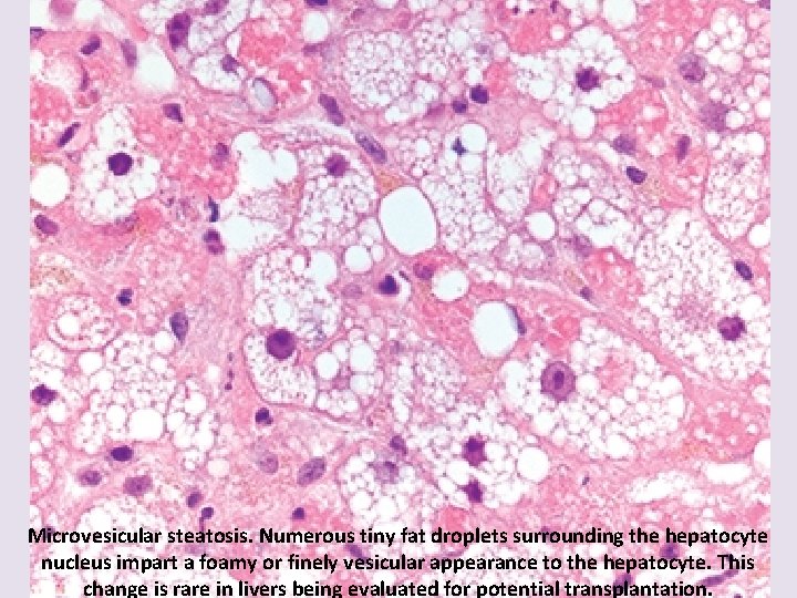 Microvesicular steatosis. Numerous tiny fat droplets surrounding the hepatocyte nucleus impart a foamy or