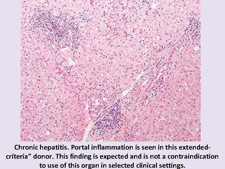 Chronic hepatitis. Portal inflammation is seen in this extendedcriteria” donor. This finding is expected