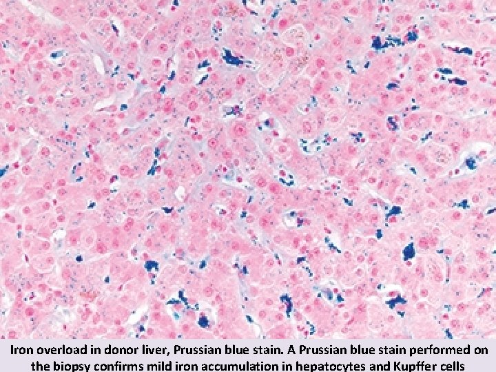 Iron overload in donor liver, Prussian blue stain. A Prussian blue stain performed on