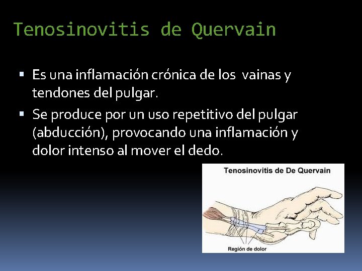 Tenosinovitis de Quervain Es una inflamación crónica de los vainas y tendones del pulgar.