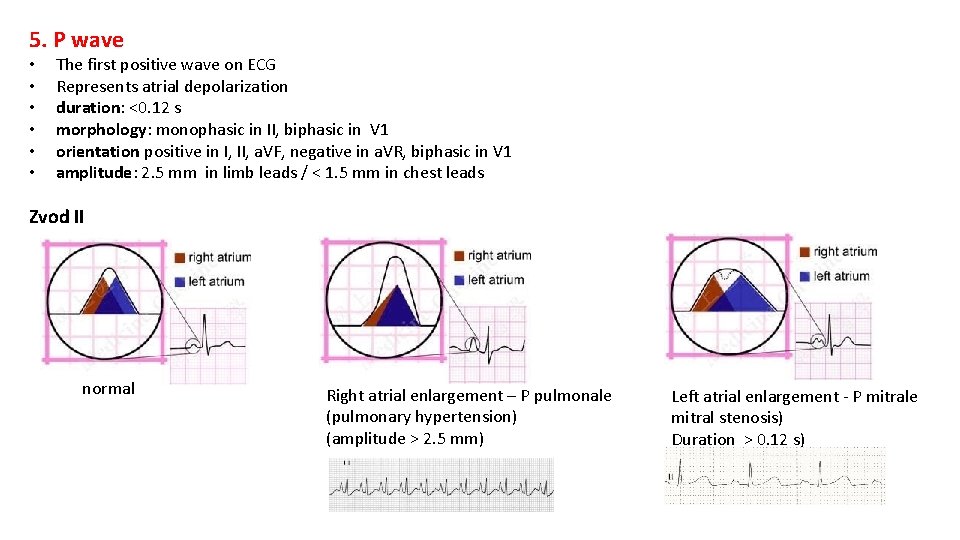 5. P wave • • • The first positive wave on ECG Represents atrial