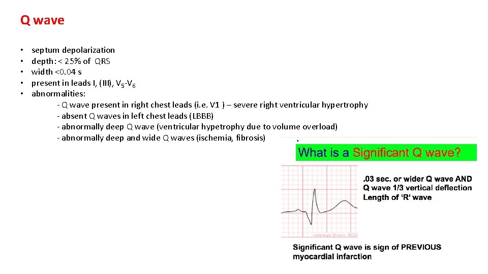 Q wave • • • septum depolarization depth: < 25% of QRS width <0.