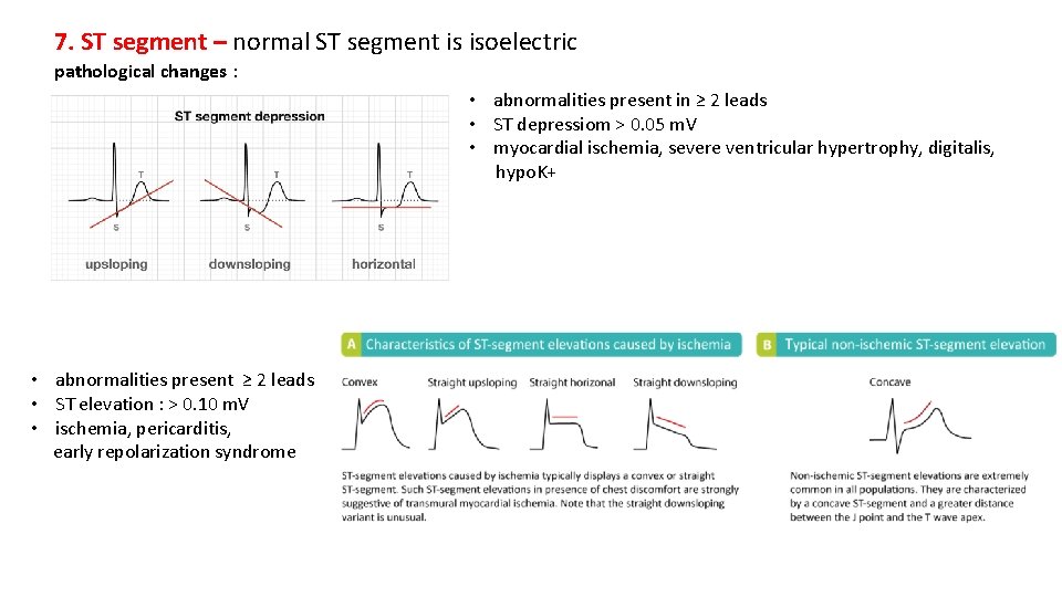 7. ST segment – normal ST segment is isoelectric pathological changes : • abnormalities