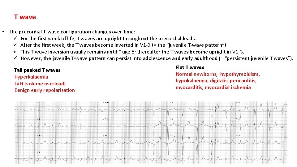 T wave • The precordial T-wave configuration changes over time: ü For the first