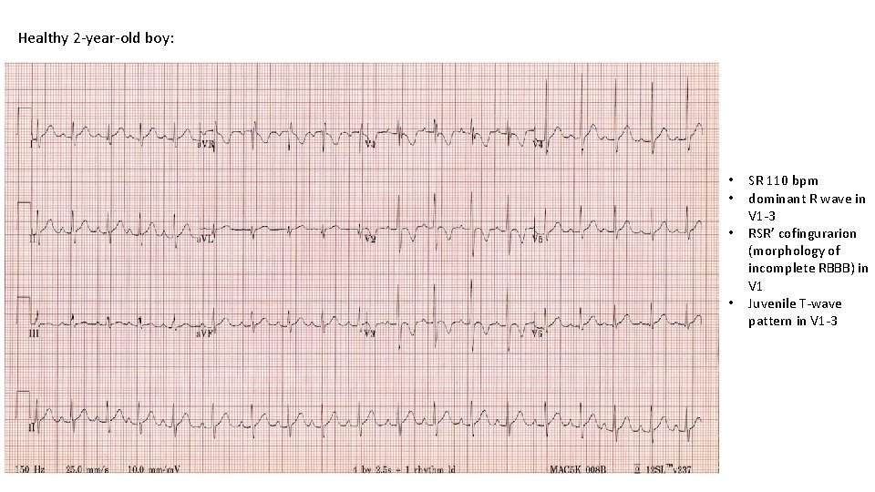 Healthy 2 -year-old boy: • • SR 110 bpm dominant R wave in V