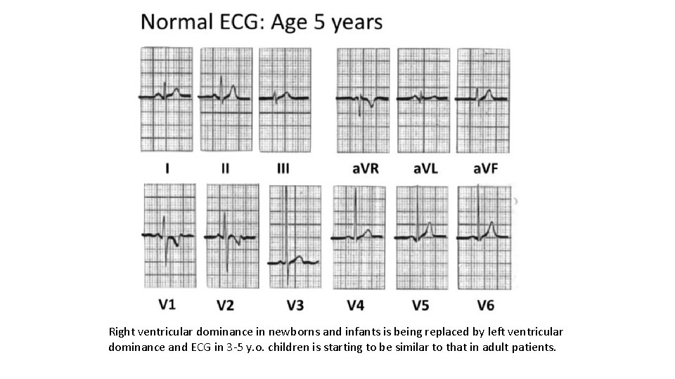 Right ventricular dominance in newborns and infants is being replaced by left ventricular dominance
