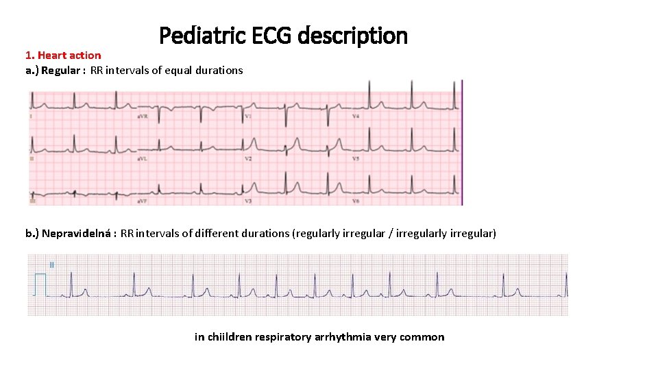 Pediatric ECG description 1. Heart action a. ) Regular : RR intervals of equal