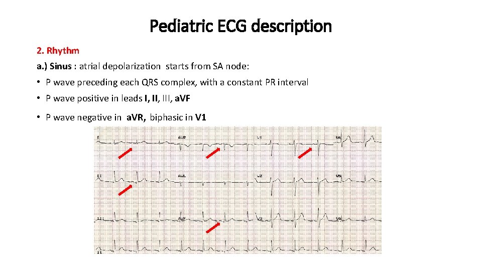 Pediatric ECG description 2. Rhythm a. ) Sinus : atrial depolarization starts from SA