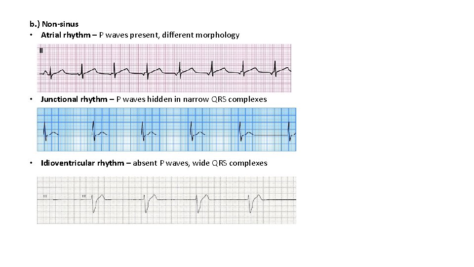 b. ) Non-sinus • Atrial rhythm – P waves present, different morphology • Junctional