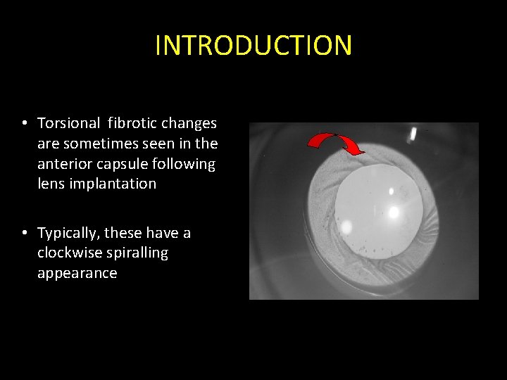 Torsional fibrosis in the anterior capsule following lens