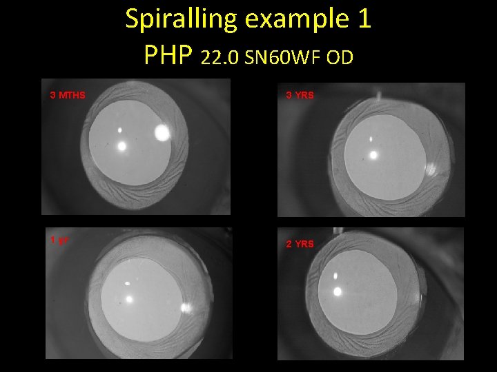 Spiralling example 1 PHP 22. 0 SN 60 WF OD 3 MTHS 3 YRS