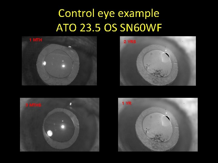 Control eye example ATO 23. 5 OS SN 60 WF 1 MTH 3 MTHS