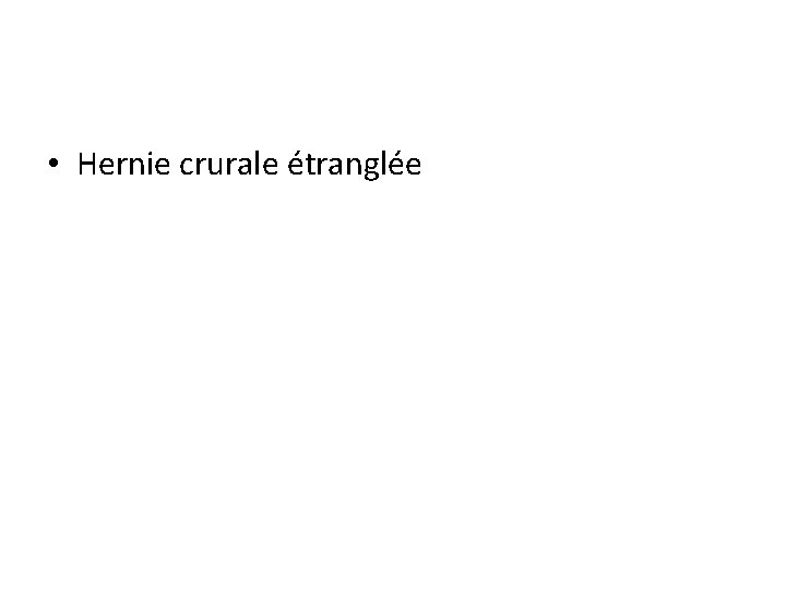  • Hernie crurale étranglée 