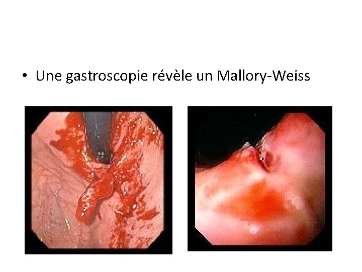  • Une gastroscopie révèle un Mallory-Weiss 