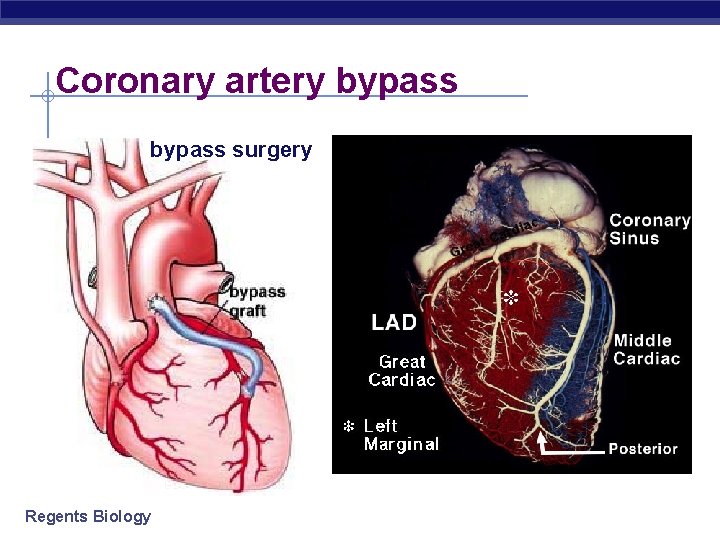 Coronary artery bypass surgery Regents Biology 