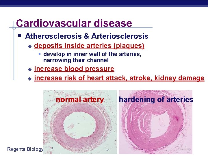 Cardiovascular disease § Atherosclerosis & Arteriosclerosis u deposits inside arteries (plaques) § develop in