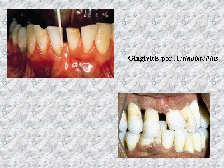 Gingivitis por Actinobacillus 
