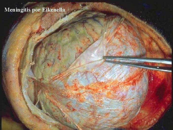 Meningitis por Eikenella 