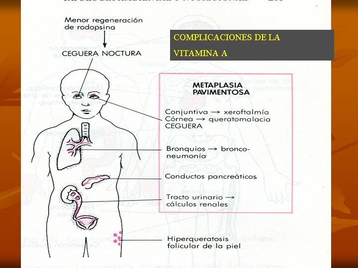 COMPLICACIONES DE DEFICIT DE VITAMINA A COMPLICACIONES DE LA VITAMINA A 