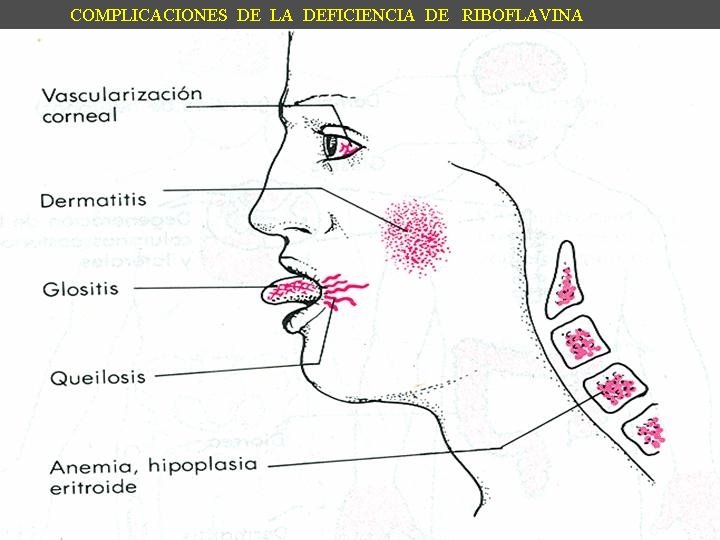 COMPLICACIONES DE LA DEFICIENCIA DE RIBOFLAVINA 