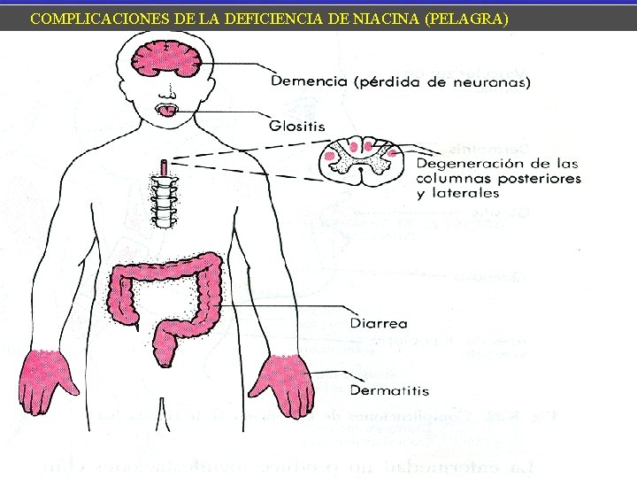 COMPLICACIONES DE LA DEFICIENCIA DE NIACINA (PELAGRA) 