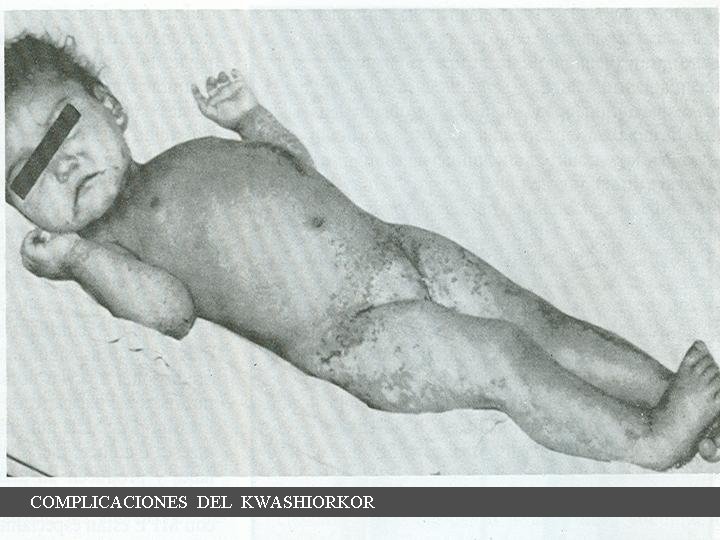 COMPLICACIONES DEL KWASHIORKOR 