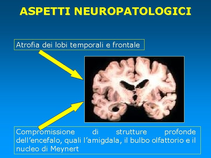 ASPETTI NEUROPATOLOGICI Atrofia dei lobi temporali e frontale Compromissione di strutture profonde dell’encefalo, quali