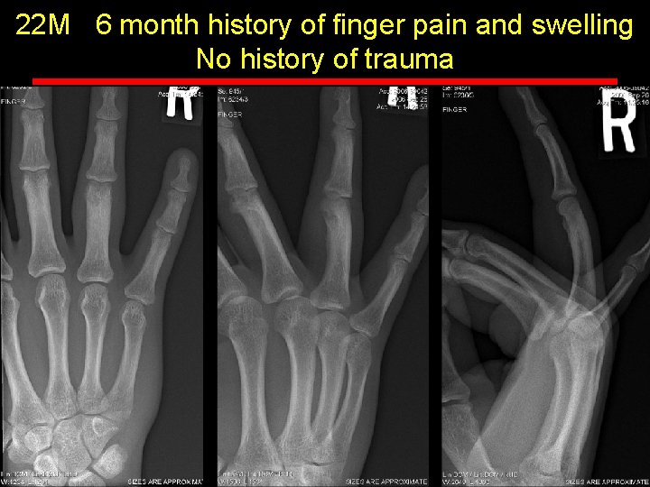 22 M 6 month history of finger pain and swelling No history of trauma