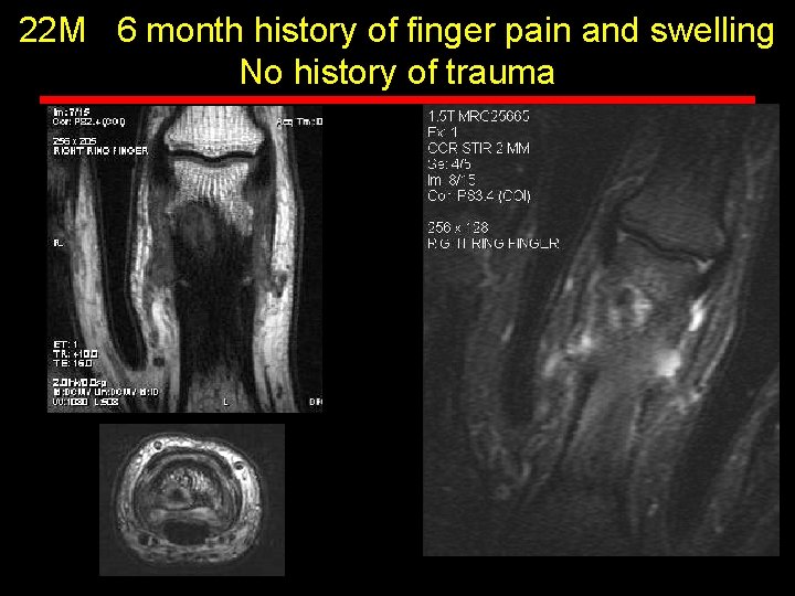 22 M 6 month history of finger pain and swelling No history of trauma