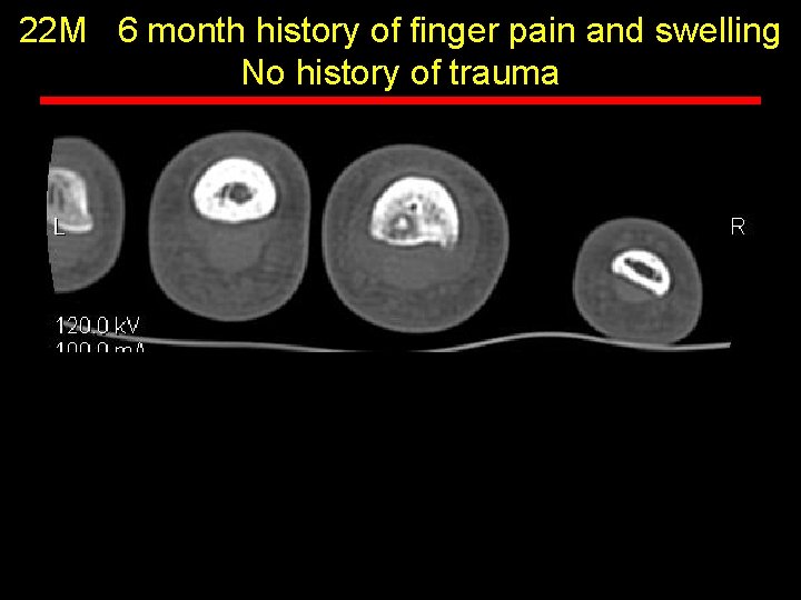 22 M 6 month history of finger pain and swelling No history of trauma