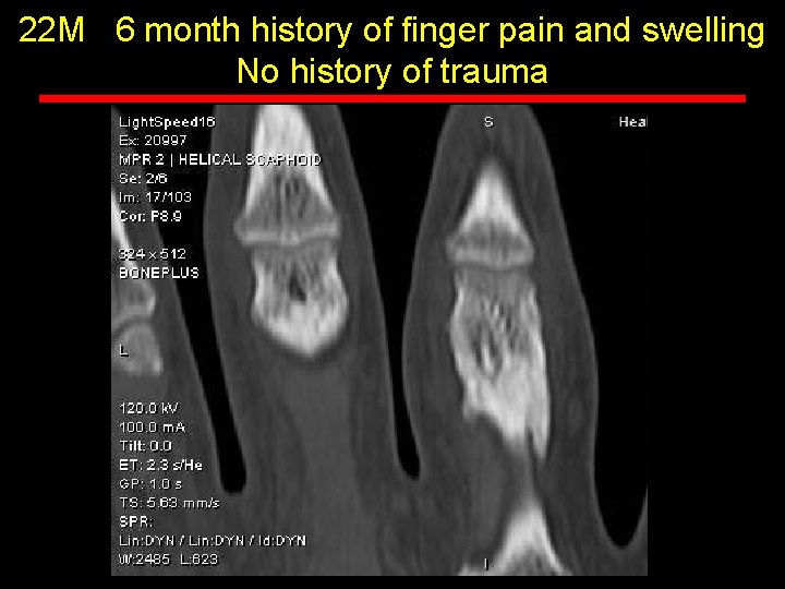 22 M 6 month history of finger pain and swelling No history of trauma