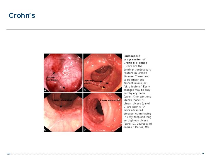 Crohn’s 10 Crohn’s 10